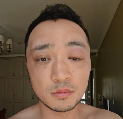 用染发剂改皮鞋颜色吗_染发过敏症状_尼格买提染发过敏原因