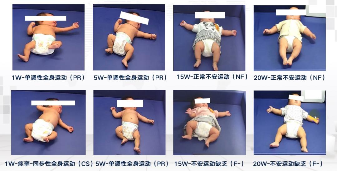 脑瘫高危儿_高危儿康复治疗_脑瘫宝宝是不是不好带