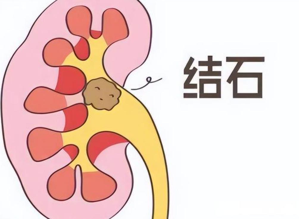 预防肾结石的饮食方法_人身体结石是怎么形成的_肾结石形成原因