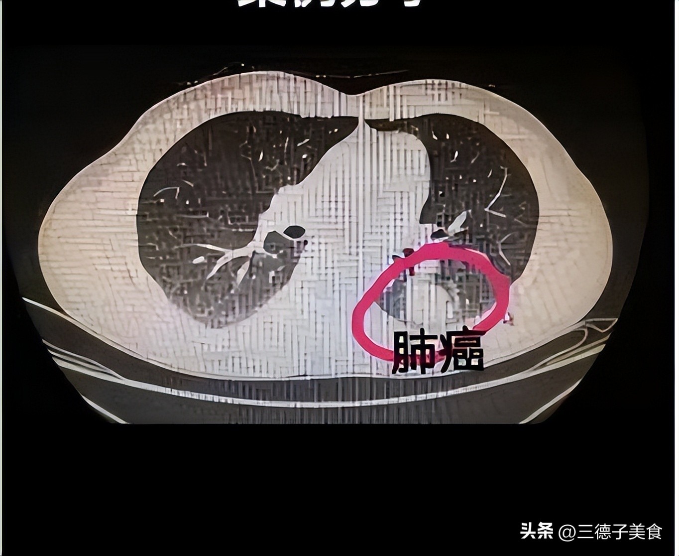 张泉灵分享生死经历_张泉灵北大毕业典礼演讲_中年人焦虑生死