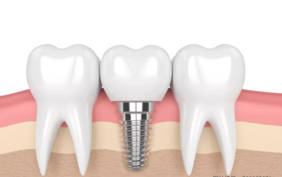 种植牙费用多少钱_种植头发需要多钱_种植牙医院医生选择