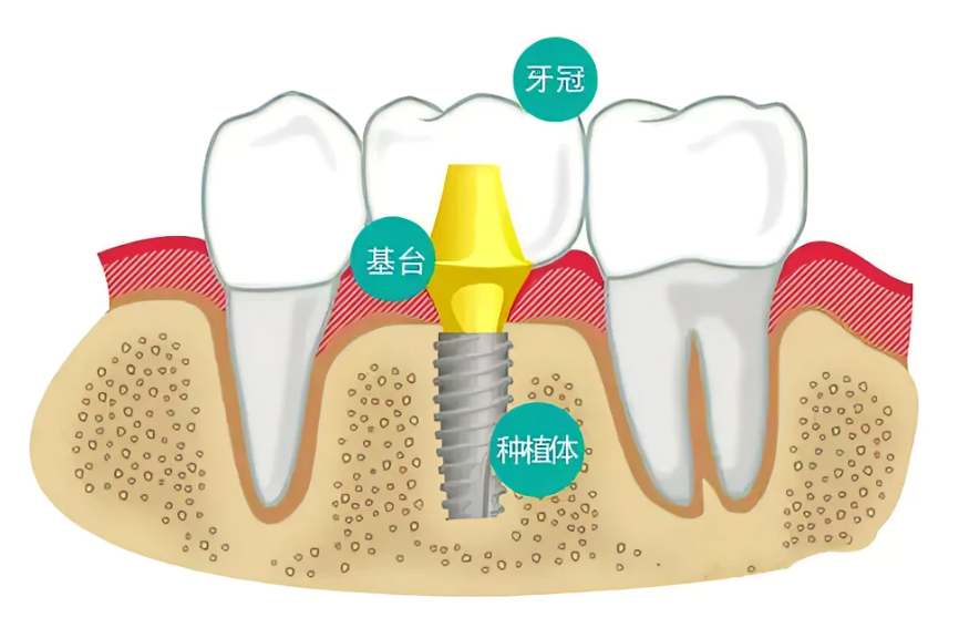 种植牙费用多少钱_种植牙医院医生选择_种植头发需要多钱