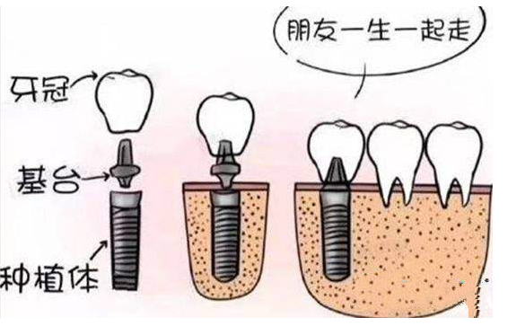 种植牙费用多少钱_种植牙医院医生选择_种植头发需要多钱