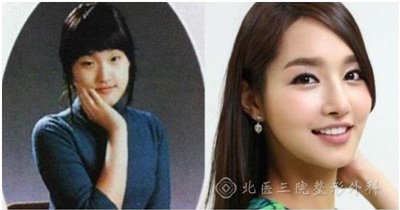 整形手术明星案例_韩国明星整容_韩国整容失败女星