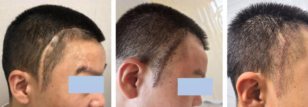 毛发种植哪里效果最好_北京朝阳医院整形外科_瘢痕性脱发毛发移植
