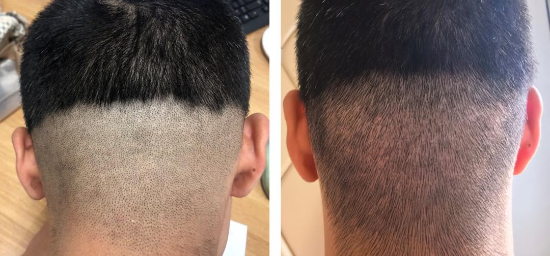 毛发种植哪里效果最好_瘢痕性脱发毛发移植_北京朝阳医院整形外科