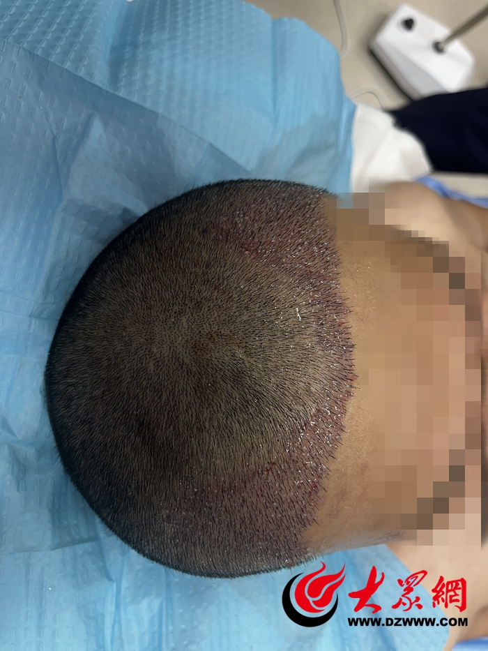 毛发种植哪里效果最好_微创式自体毛发移植术_菏泽市中医医院毛发移植术