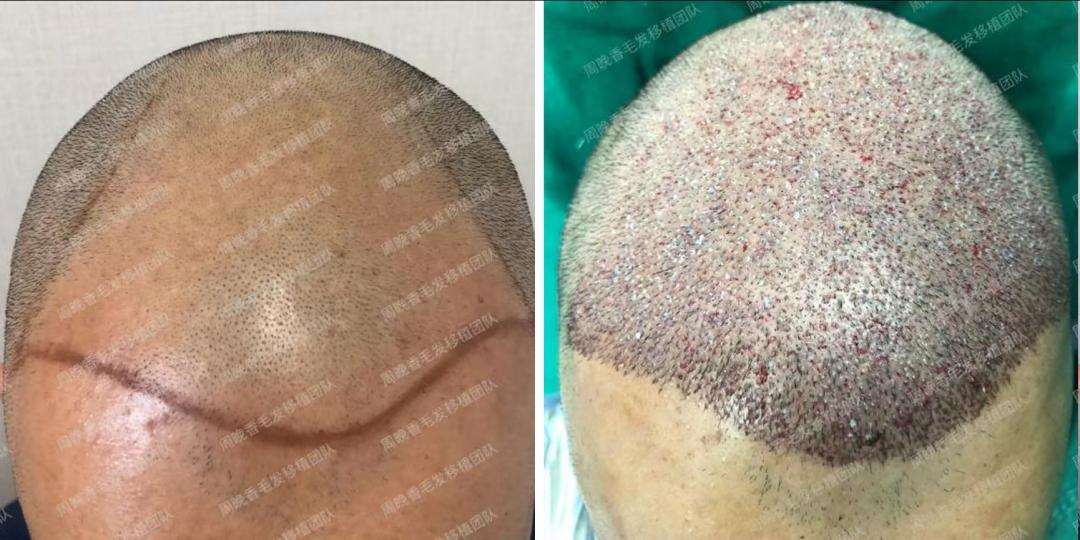 毛发种植哪里效果最好_FUE技术毛发移植效果_北京朝阳医院自体毛发移植术