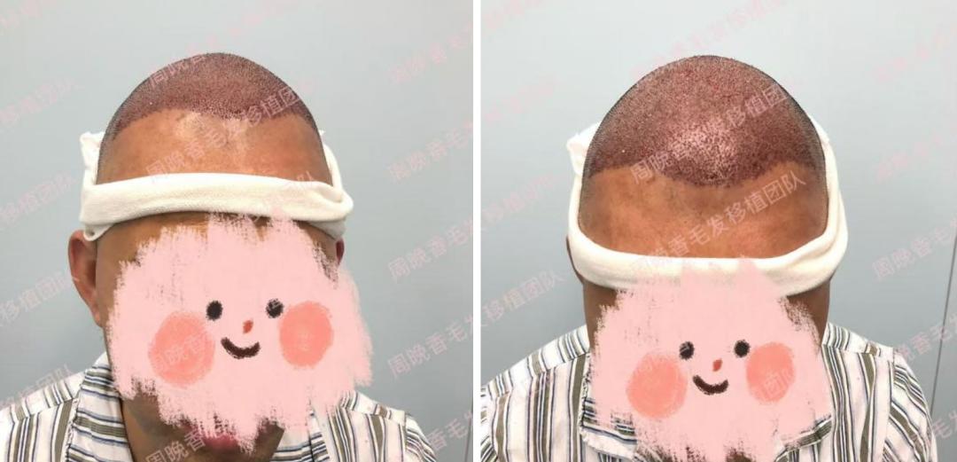毛发种植哪里效果最好_北京朝阳医院自体毛发移植术_FUE技术毛发移植效果