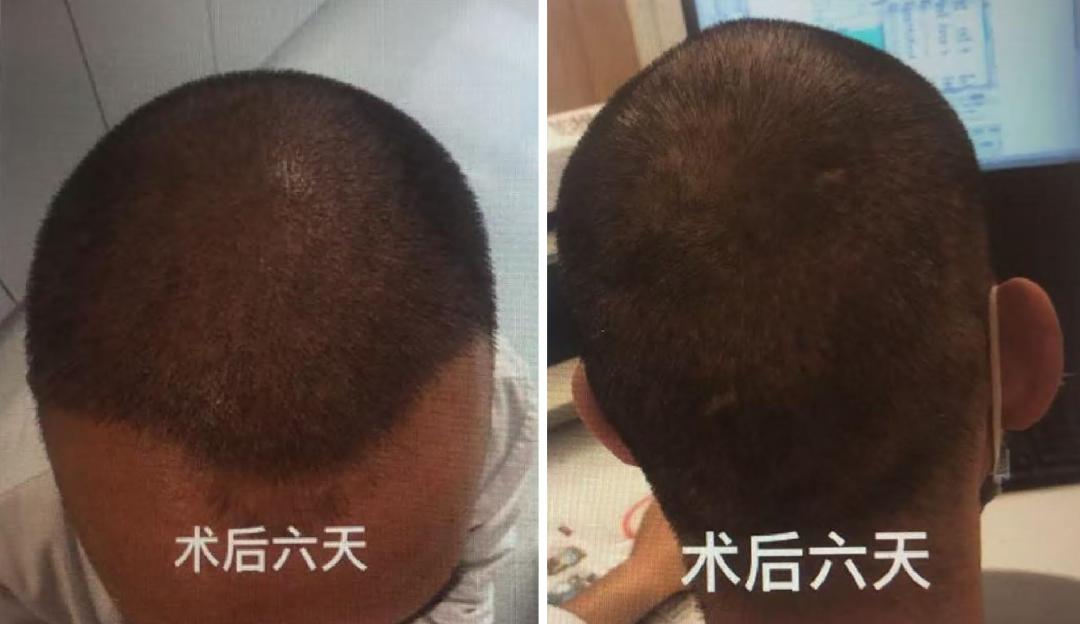 北京朝阳医院自体毛发移植术_FUE技术毛发移植效果_毛发种植哪里效果最好
