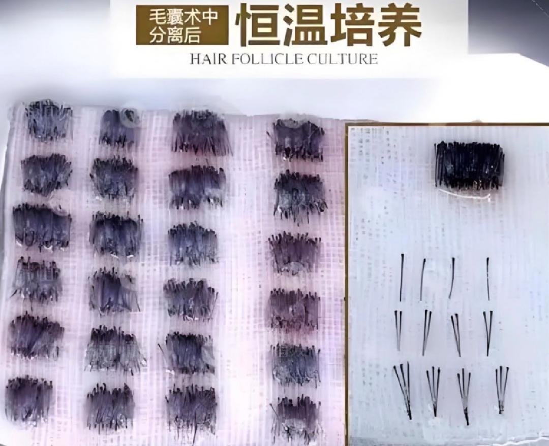 毛发种植哪里效果最好_北京朝阳医院自体毛发移植术_FUE技术毛发移植效果