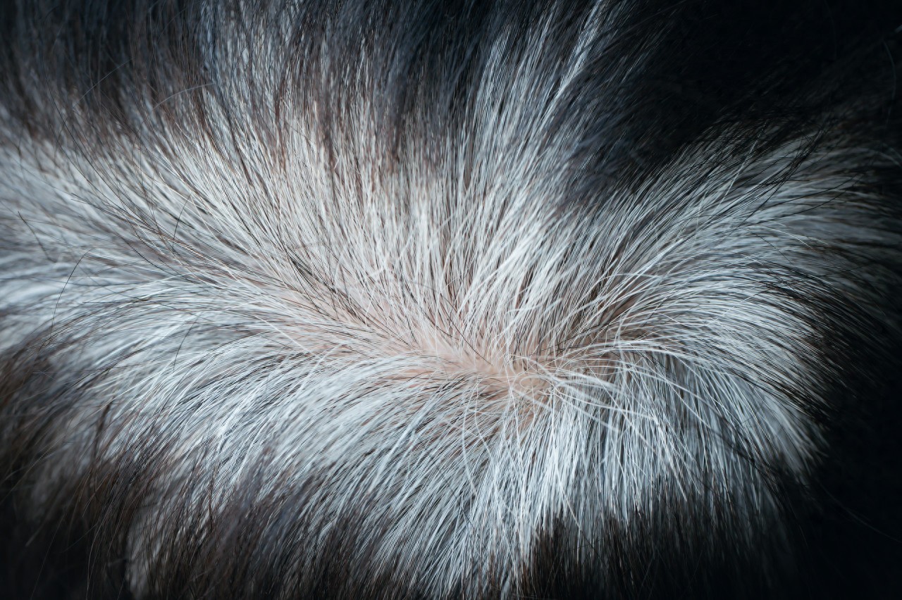 精神压力白发_斑秃长一截变白又断掉是什么原因_黑素干细胞消耗