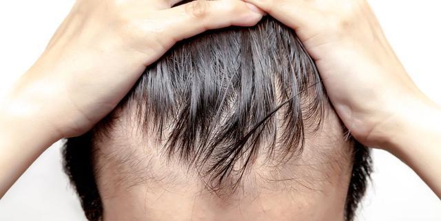 掉头发营养补充_吃什么可以长头发_干细胞毛囊再生技术