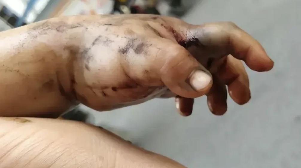 蛇咬伤应急处理方法_孩子爸爸发现孩子被蛇咬伤_蛇吃小孩图片