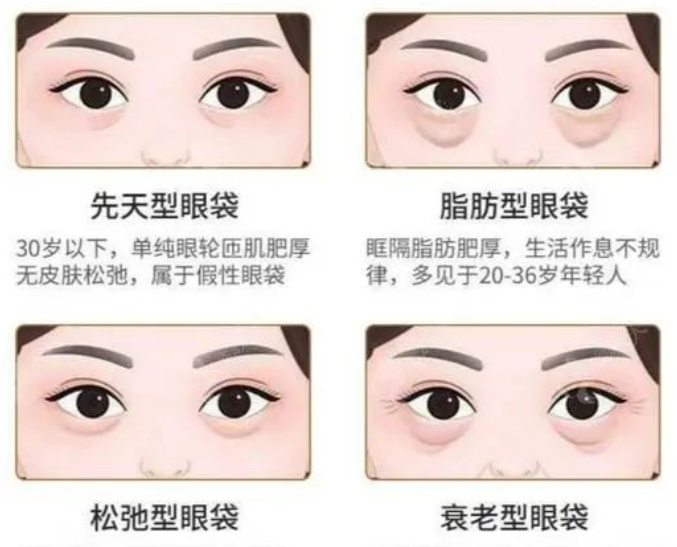 眼袋形成原因_泡沫去眼袋是真的假的_假性眼袋如何消除