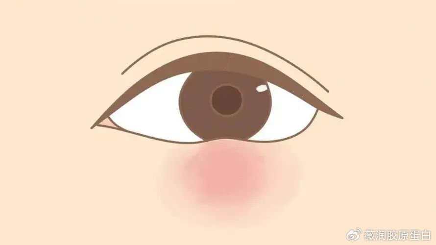 假性眼袋如何消除_眼袋形成原因_泡沫去眼袋是真的假的
