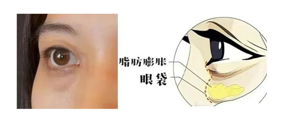假性眼袋如何消除_泡沫去眼袋是真的假的_眼袋形成原因