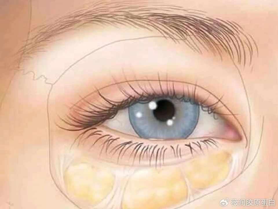 假性眼袋如何消除_眼袋形成原因_泡沫去眼袋是真的假的